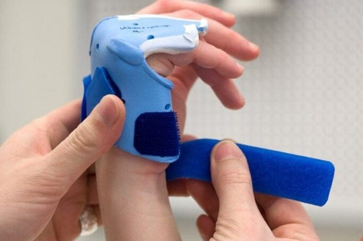 Nahaufnahme von Haenden einer Ergotherapeutin die einem Patienten eine Schiene an der Hand anpasst in der Handtherapie des VAMED Rehazentrum Karlsruhe